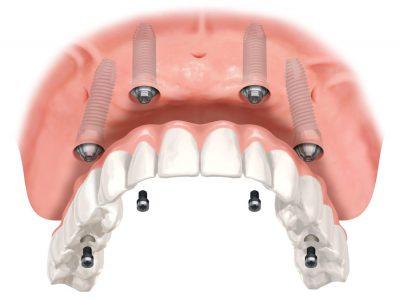 Upper bridge on four implants with screws 400x300 1