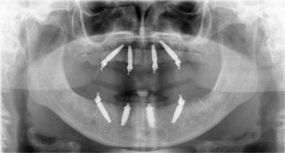 all on 4 x ray long term temporary implant 400x215 1