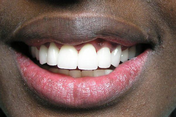 beautiful teeth after restoration 600x400 1