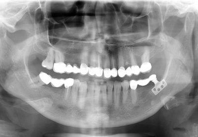 blade implant loaded 400x276 1