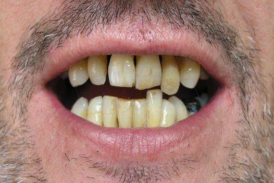 crooked teeth before treatment 400x267 1