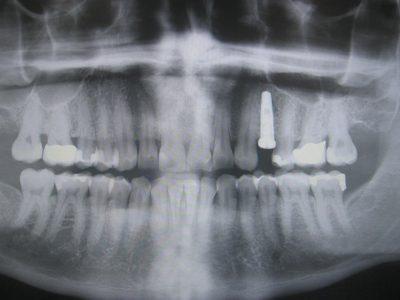 immediate implantation 400x300 1