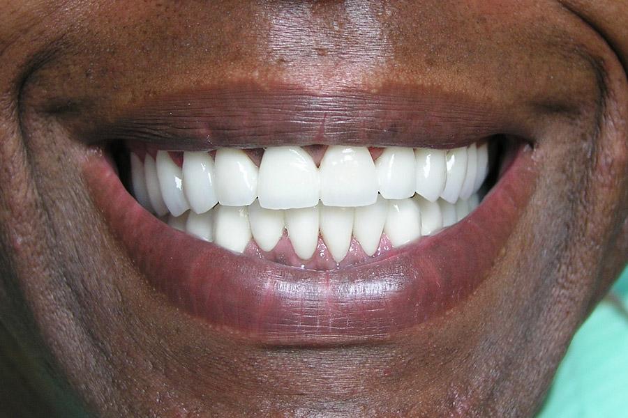 smile makeover after treatment