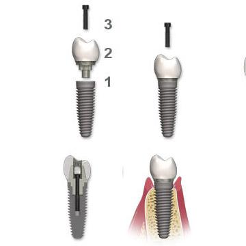 two peace implants with screw retained crowns