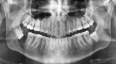 wisdom tooth and cyst 32 400x221 1